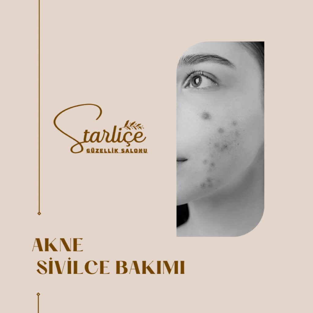 AKNE VE SİVLİCE BAKIMI