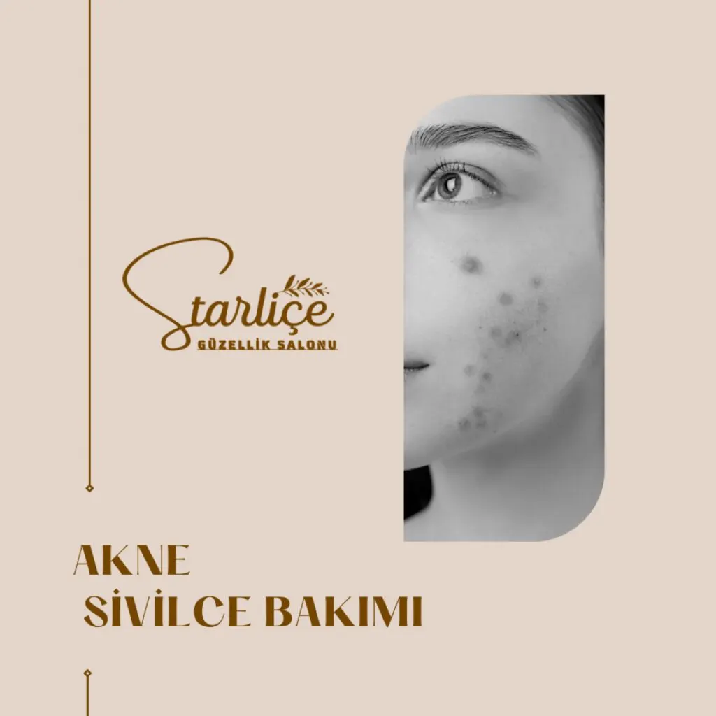 Akne ve Sivilce Bakımı — Starliçe Güzellik Esenler